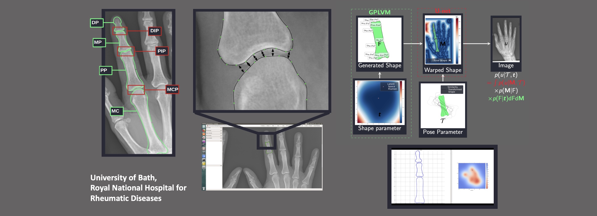 PhD Position: Machine Learning for Structural Damage Detection in Psoriatic Arthritis Hand Radiographs